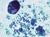 Multinuleated__giant_cells_and_follicular_cells_in_benign_thyroid_nodule-pap-high-zhang.jpg