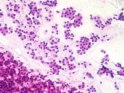 Hurthle Cell Neoplasm - Hurthle cells (oncocytes). - IMAGE ...
