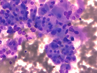 Hurthle cells (oncocytes).
Keywords: Hurthle Cell Adenoma, Follicular Adenoma