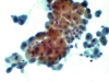 follicular_neoplasm_hurthle_cell_type-fu_hurthle_cell_adenoma-pap14-high-sturgis.jpg