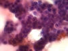 follicular_neoplasm_hurthle_cell_type-fu_hurthle_cell_carcinoma-pap19b-high-sturgis.jpg