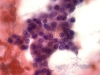 follicular_neoplasm_hurthle_cell_type-fu_hurthle_cell_carcinoma-pap19e-high-sturgis.jpg