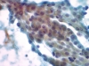 follicular_neoplasm_hurthle_cell_type-fu_hurthle_cell_carcinoma-pap6-high-sturgis.jpg