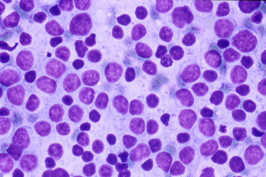 Large_Cell_Lymphoma_1~0.jpg