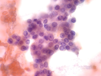 Hurthle Cells
Aggregate of Hurthle Cells from Hurthle Cell Neoplasm. Stimulated enlarged nuclei are present with prominent nucleoli.
Keywords: Hurthle Cells, Hurthle cell neoplasm