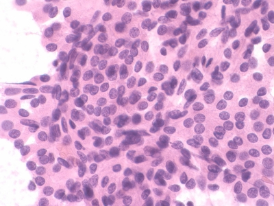 Hurthle Cells (oncocytes)
Hurthle cell neoplasm with some unusual features. There is ample cytoplasm, but nuclei are not as open, darker than usual, and nucleoli are not prominent.
Keywords: Hurthle Cells, Hurthle cell neoplasm
