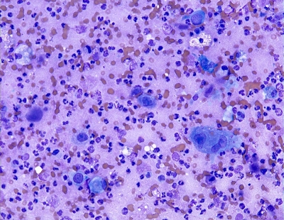 Pleomorphic cells with necrosis.
Keywords: Undifferentiated, Anaplastic, Carcinoma