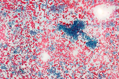 Cellular sample with numerous non-cohesive cells.
Keywords: undifferentiated, Anaplastic, Carcinoma