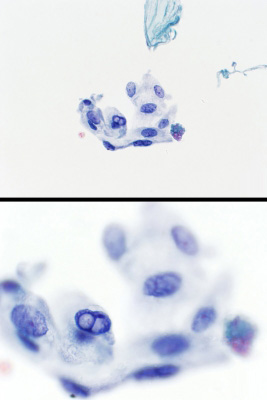 AUS/FLUS.
Atypical cyst lining cells (ThinPrep®) (Bethesda monograph, pages 38-9: scenario 6).
Keywords: AUS Scenario 6