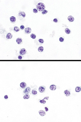 AUS.
Atypical lymphoid cells (ThinPrep®) (Bethesda monograph, pages 38-9: scenario 8).
Keywords: AUS Scenario 8