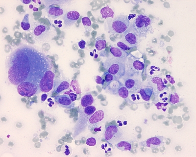 Romanowsky-stained poorly differentiated cells.
Keywords: Anaplastic Carcinoma