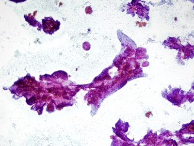 Benign follicular cells showing pseudopapillary hyperplasia.
Keywords: Papillary Hyperplasia, Benign Thyroid Nodule, "Pseudopapillary Hyperplasia"