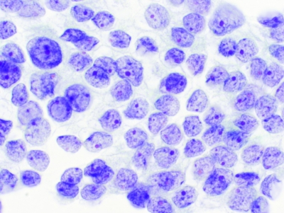 Finely textured chromatin and intranuclear pseudoinclusions.
Keywords: Papillary Carcinoma, liquid based, ThinPrep