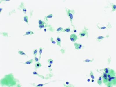 anaplastic Carcinoma of Thyroid in liquid base prep
Cells with variation in size and shape. Because of tendency of cells to round up in liquid preparations, cells much be evaluated in context of other cells present including inflammatory cells.
Keywords: anaplastic Carcinoma, liquid based preparation
