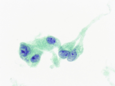 Epithelioid and spindle-shaped cells (ThinPrep).
Keywords: Spindle cells on ThinPrep®