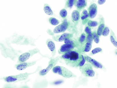 Spindle-shaped cells (ThinPrep).
Keywords: Medullary Carcinoma, ThinPrep®