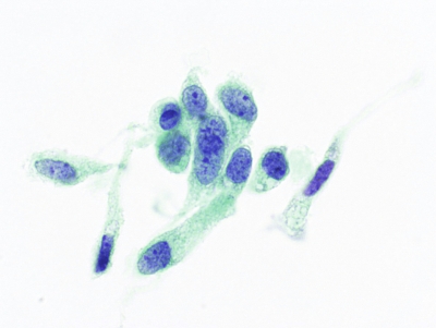 Spindle-shaped cells (ThinPrep).
Keywords: Medullary Carcinoma, ThinPrep®