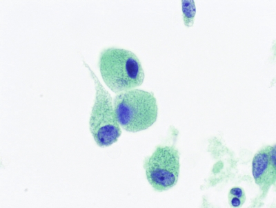Isolated plasmacytoid cells with karyomegaly (ThinPrep).
Keywords: Medullary Carcinoma