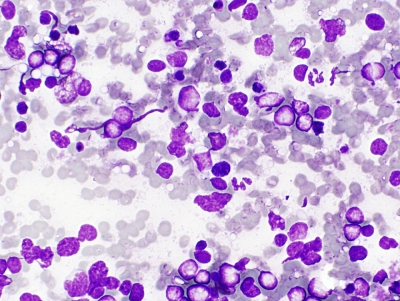 Diffuse large B cell lymphoma.
Keywords: Diffuse large B cell lymphoma, NHL, Non-hodgkin lymphoma