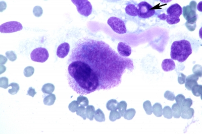 Large epithelioid cells. rare intranuclear inclusion (arrow), red calcitonin granules, and amyloid.
Keywords: Medullary, Carcinoma, Neuroendocrine