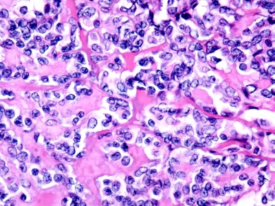 Histologic image with abundant amyloid.
Keywords: Medullary Carcinoma, Amyloid, Histology