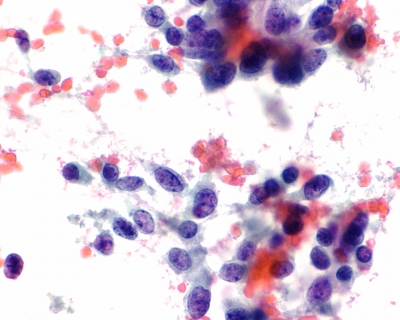 Sparsely cellular sample with epithelioid and fusiform cells.

