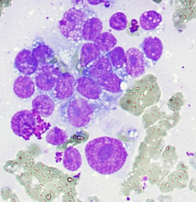 Breast Carcinoma Metastatic to Thyroid
Clearly malignant cells found on thyroid aspiration in woman with history of widespread breast carcinoma
Keywords: Metastatic, Breast Carcinoma, 