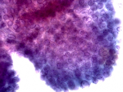 Crowded cells with powdery chromatin.
Keywords: Papillary Thyroid Carcinoma, Crowded Cells with Powdery Chromatin