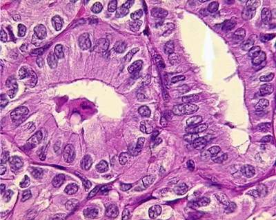 Papillary Carcinoma of Thyroid - Tall Cell Variant
By definition, the cells of the tall cell variant are three or more times longer than they are wide (histologic specimen).
Keywords: Papillary Thyroid Carcinoma, Tall Cell Variant (PTC TCV): 