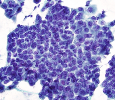 Papillary CA, disordered nuclei in sheet of tumor
Keywords: Papillary _Carcinoma, disordered sheets, nucleoli