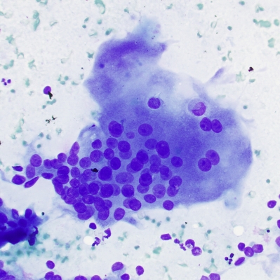 Multinucleated giant cell in papillary carcinoma
These inflammatory type giant cells are sometimes seen in papillary carcinoma
Keywords: Giant Cell Papillary Carcinoma