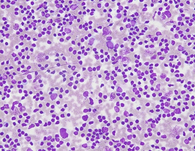 Polymorphous population of atypical lymphoid cells.
Keywords: Suspicious, Lymphoma, Malignancy