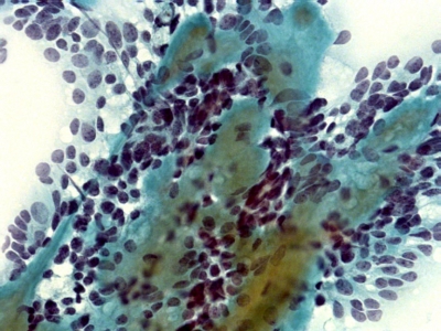 Fusiform (spindle-shaped cells) and amyloid.
Keywords: Medullary Carcinoma, Spindle Cell