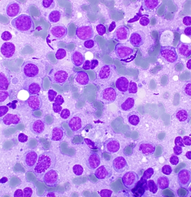 Plasmacytoid B-Cell Lymphoma in Thyroid FNA
Dyscohesive malignant cells from a thyroid FNA. cd20 positive
Keywords: Plasmacytoid B-Cell Lymphoma 