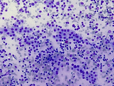 Polymorphous lymphocytes and Hurthle cells.
Keywords: Hashimoto, Autoimmune, Chronic Lymphocytic Thyroiditis
