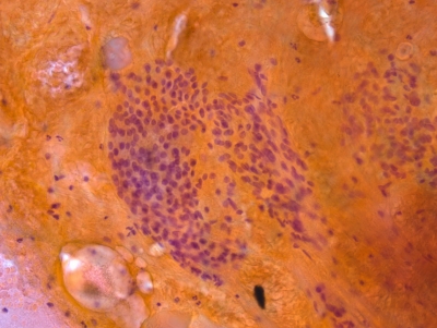 Atypia of Undetermined Significance/Follicular Lesion of Undetermined Significance
Representative of sample showing aggregates of degenerate follicular cells in a bloody sample. Probably benign, but the cellularity and nuclear overlap caused insecurity in the observer's opinion. Thus AUS.
Keywords: Atypia of Undetermined Significance