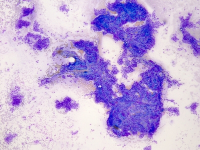 Papillary thyroid carcinoma (low magnification).
Keywords: Papillary Carcinoma Low Power
