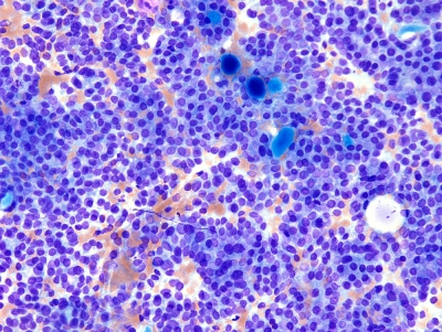 Papillary thyroid carcinoma (low magnification).
Keywords: Papillary Thyroid Carcinoma - low power