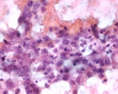 Large pleomorphic cells in a sparsely cellular sample.
Keywords: Suspicious for Neoplasm
