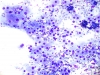 Lymph_thyroiditis,_predom_Hurthle_cells_from_dom_nodule,_DQ_SM.jpg