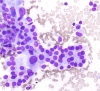 Lymph_thyroiditis-_microfollicle_formation_in_oncocytes_lp_DQ_SM.jpg