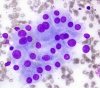 Lymphocytic_thyroiditis-_Reactive_oncocytes_with_lymphoid_cell_to_right_hp_DQ_SM.jpg