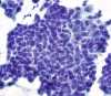 Papillary_CA,_disordered_nuclei_in_sheet_of_tumor,_PAP_sm.jpg