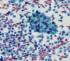 chronic_Lymphocytic_thyroiditis-_Follicular_cells_with_juxtaposed_mixed_lymphocytes-PAP_high-crothers.jpg