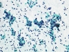 chronic_lymphocytic_thyroiditis-Hurthle_cells_and__lymphocytes-pap-medium-zhang400x4.jpg