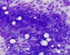 chronic_lymphocytic_thyroiditis-_oncocytes_mixed_into_dense_lymphoid_population-dq-high-crothers-2.jpg