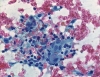 subacute_granulomatous_thyroiditis-An_admixture_of_epithelioid_histiocytes,_multinucleated_giant_cells_and_lymphocytes-pap-high-ali.JPG