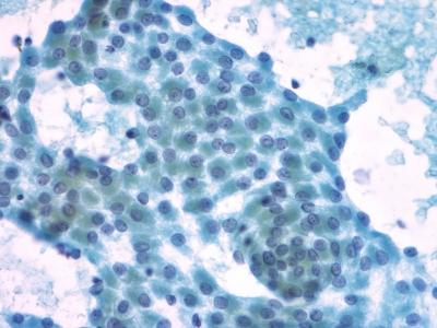 Hurthle Cell Neoplasm - Hurthle cells (oncocytes). - IMAGE ATLAS